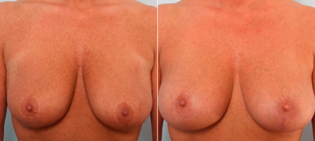 Patient 27516, Breast Lift with Augmentation before and after photos Breast Lift with Augmentation before and after photos in Houston, TX, Patient 27516
