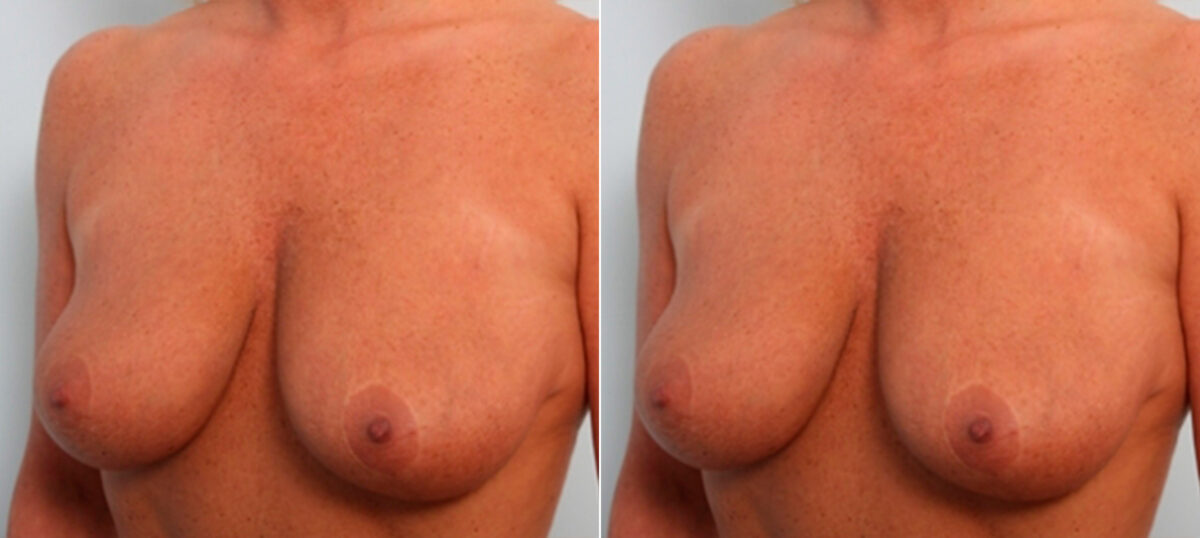Breast Lift with Augmentation before and after photos in Houston, TX, Patient 27516