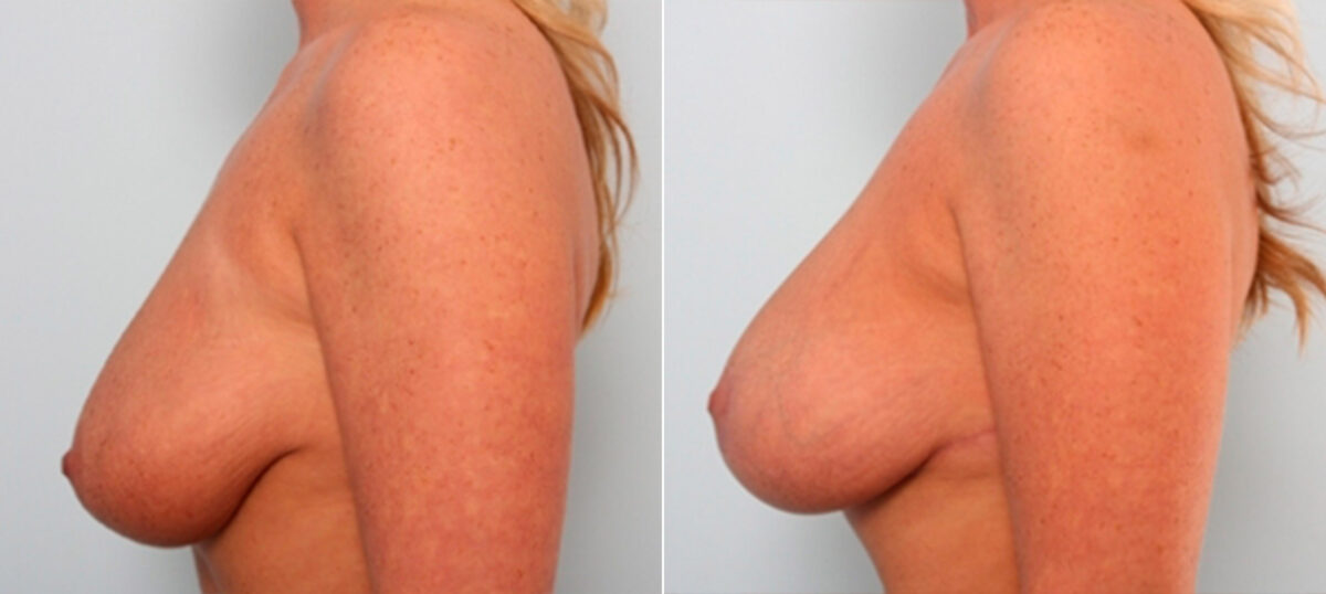 Breast Lift with Augmentation before and after photos in Houston, TX, Patient 27516