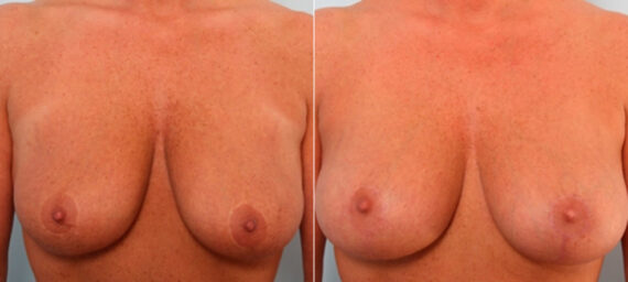 Breast Lift with Augmentation before and after photos in Houston, TX, Patient 27516