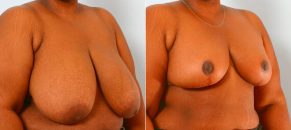 Breast Reduction before and after photos in Houston, TX, Patient 27538