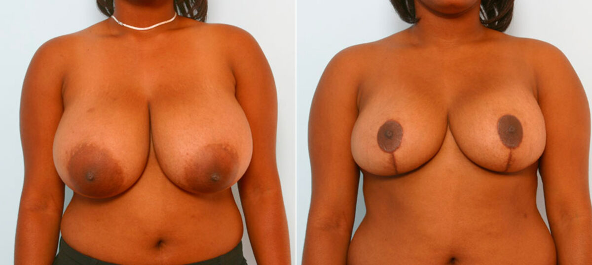 Breast Reduction before and after photos in Houston, TX, Patient 27545