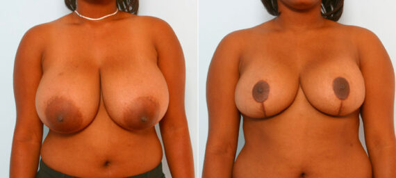 Breast Reduction before and after photos in Houston, TX