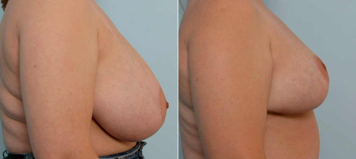 Breast Reduction before and after photos in Houston, TX, Patient 27559
