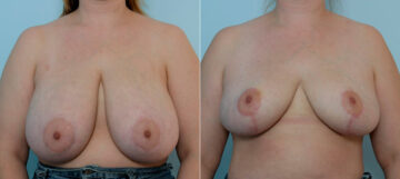 Breast Reduction before and after photos in Houston, TX, Patient 27559