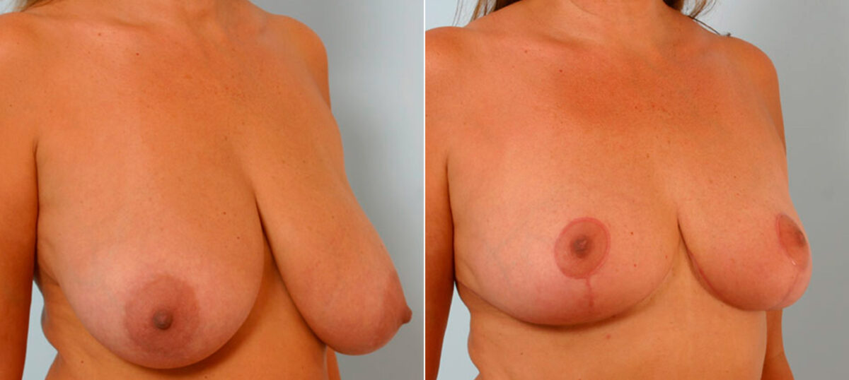 Breast Reduction before and after photos in Houston, TX, Patient 27587