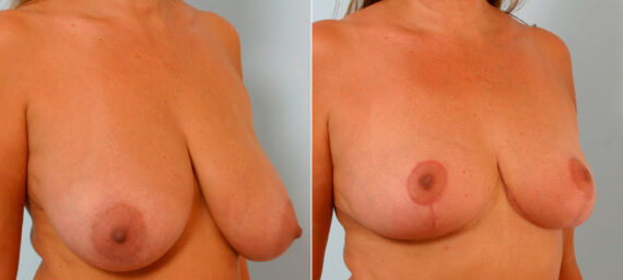 Breast Reduction before and after photos in Houston, TX, Patient 27587