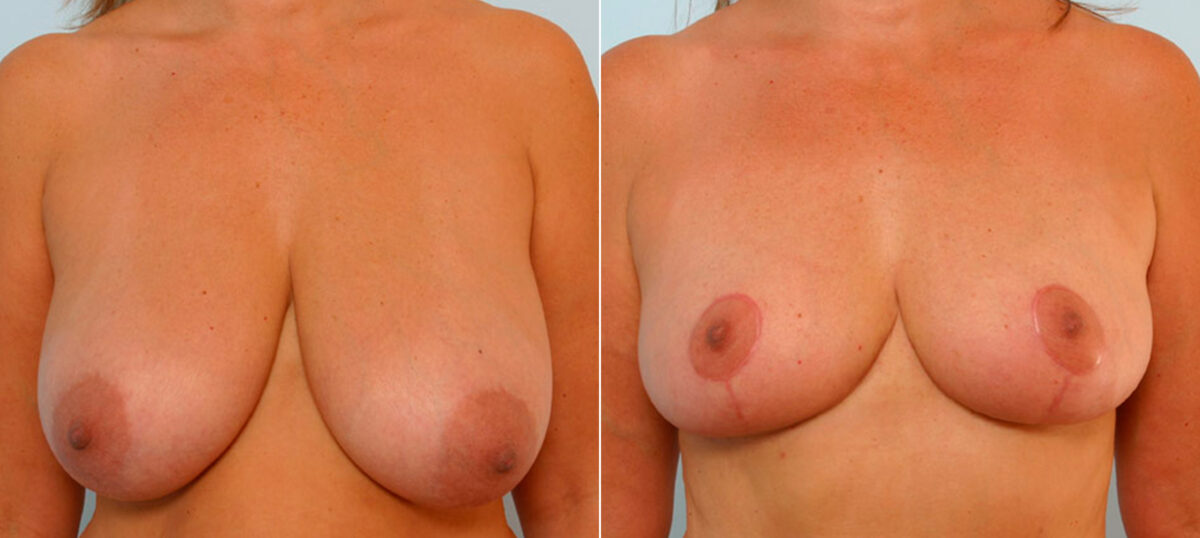 Patient 27587, Breast Reduction before and after photos Breast Reduction before and after photos in Houston, TX, Patient 27587