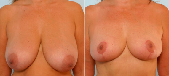 Breast Reduction before and after photos in Houston, TX, Patient 27587
