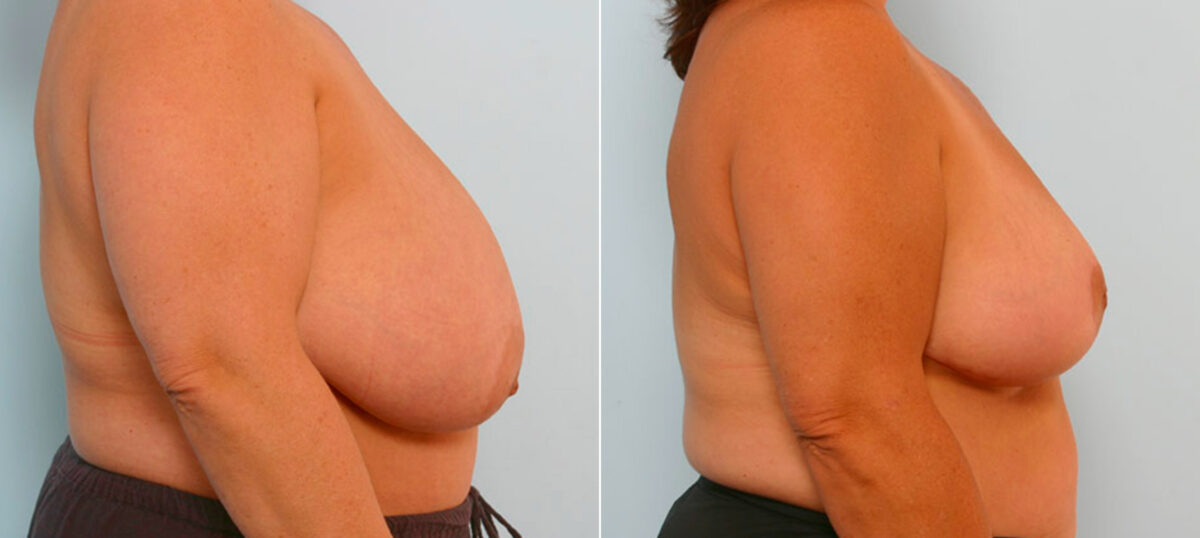 Breast Reduction before and after photos in Houston, TX, Patient 27622