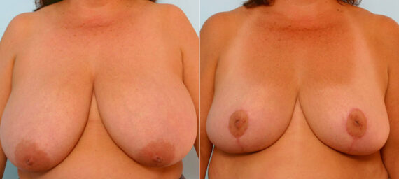 Breast Reduction before and after photos in Houston, TX, Patient 27622