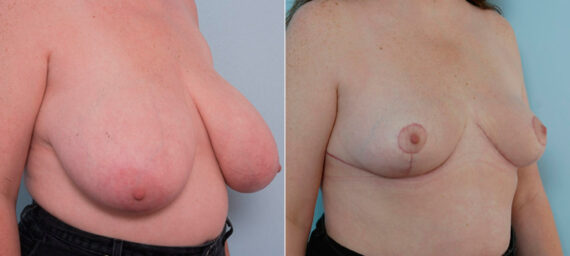 Breast Reduction before and after photos in Houston, TX, Patient 27629