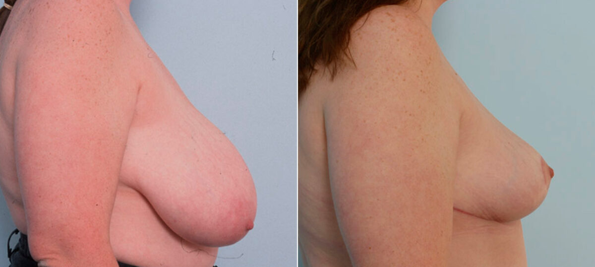 Breast Reduction before and after photos in Houston, TX, Patient 27629