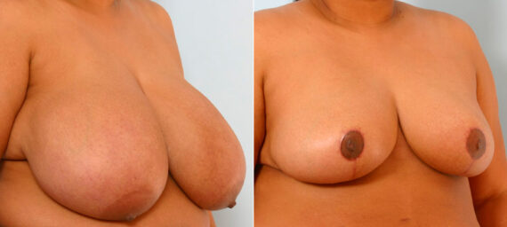 Breast Reduction before and after photos in Houston, TX, Patient 27636