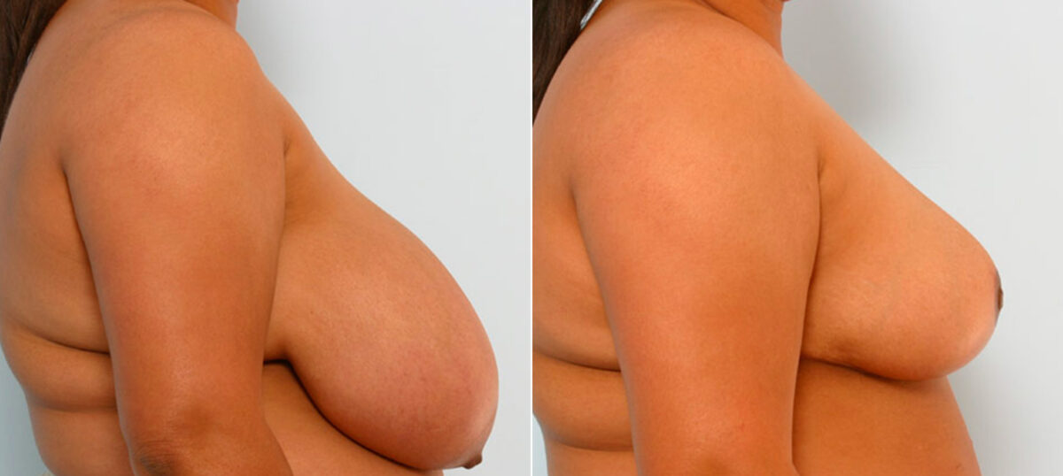 Breast Reduction before and after photos in Houston, TX, Patient 27636