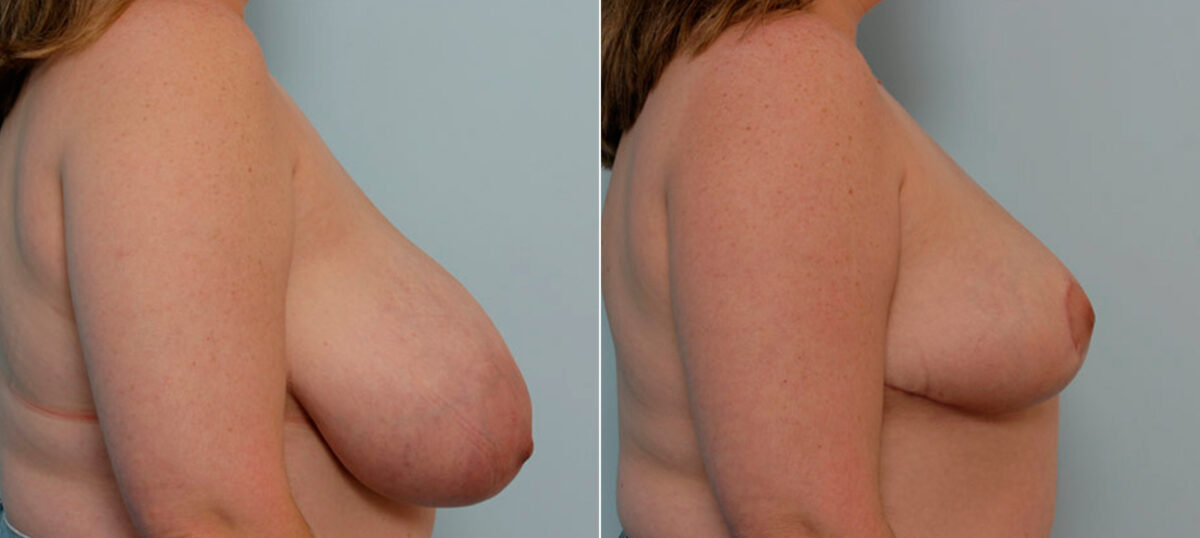 Breast Reduction before and after photos in Houston, TX, Patient 27643