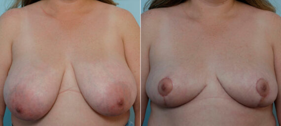 Breast Reduction before and after photos in Houston, TX, Patient 27643