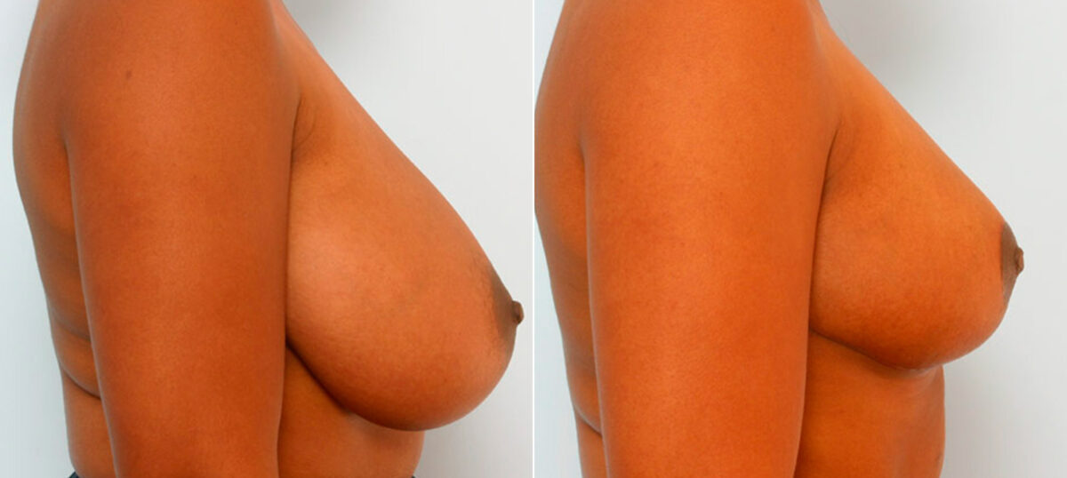 Breast Reduction before and after photos in Houston, TX, Patient 27650