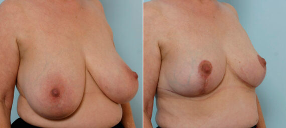 Breast Reduction before and after photos in Houston, TX, Patient 27664