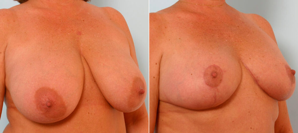 Breast Reduction before and after photos in Houston, TX, Patient 27671