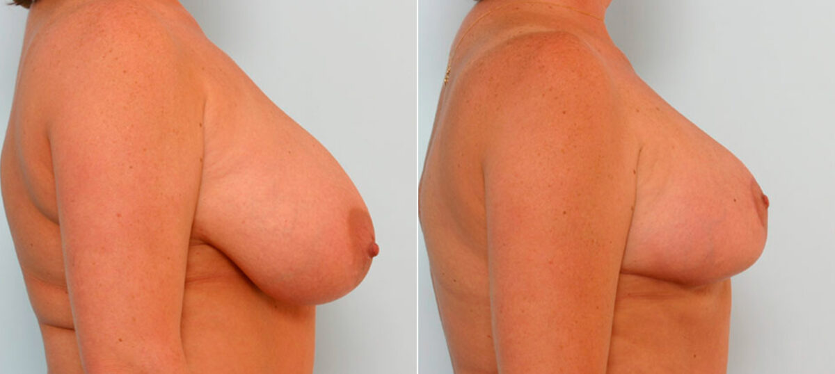 Breast Reduction before and after photos in Houston, TX, Patient 27671
