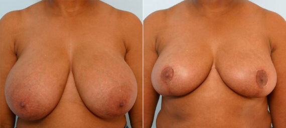 Breast Reduction before and after photos in Houston, TX, Patient 27678