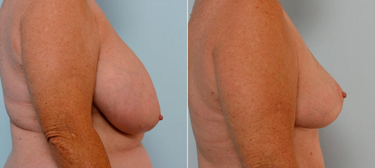 Breast Reduction before and after photos in Houston, TX, Patient 27699