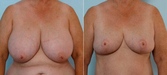 Breast Reduction before and after photos in Houston, TX, Patient 27699