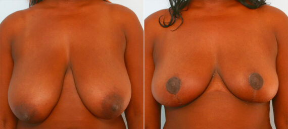 Breast Reduction before and after photos in Houston, TX, Patient 27713