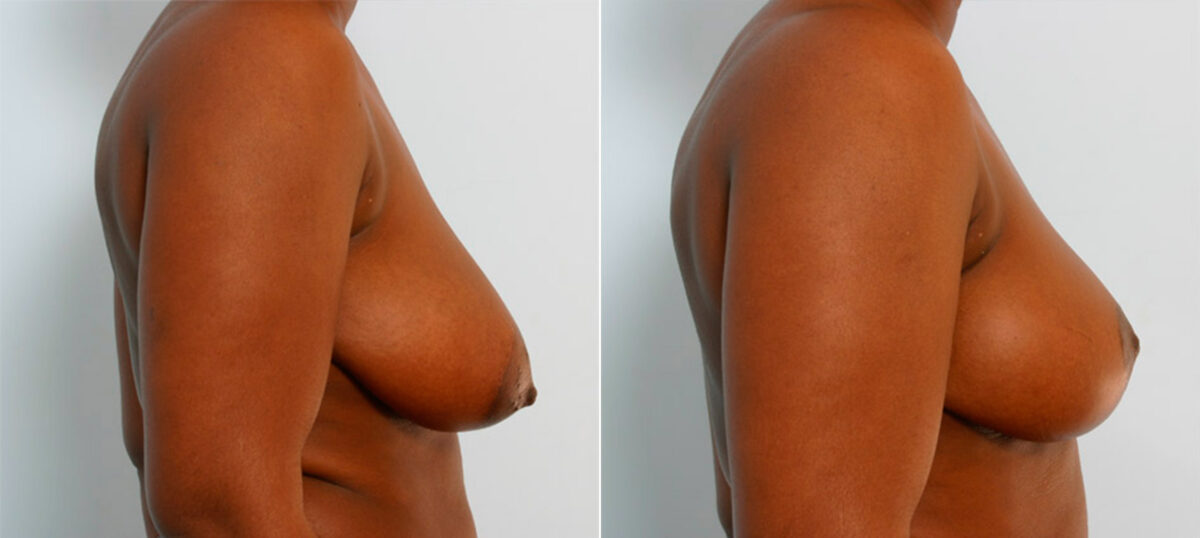 Breast Reduction before and after photos in Houston, TX, Patient 27725