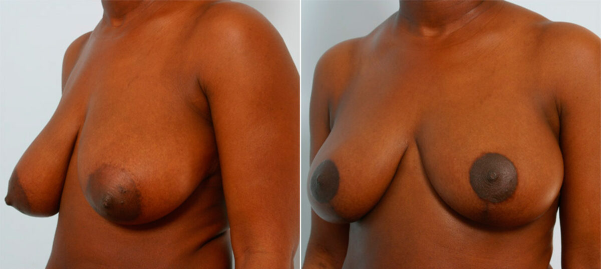 Breast Reduction before and after photos in Houston, TX, Patient 27725