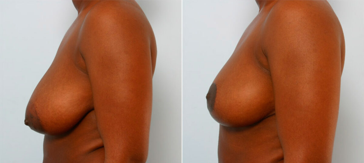 Breast Reduction before and after photos in Houston, TX, Patient 27725