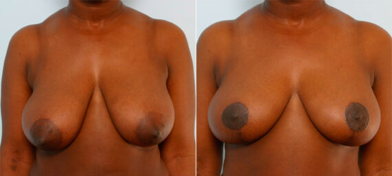 Breast Reduction before and after photos in Houston, TX, Patient 27725