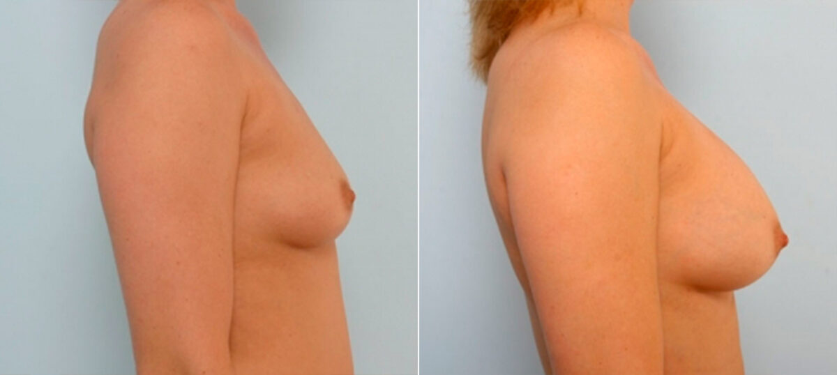 Breast Augmentation before and after photos in Houston, TX, Patient 34686