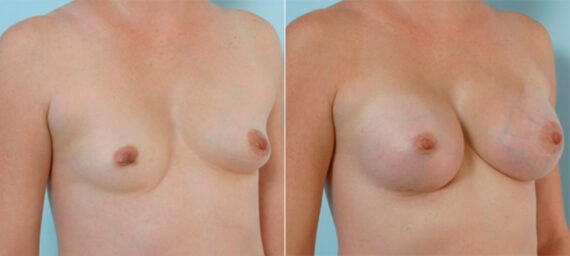 Breast Augmentation before and after photos in Houston, TX, Patient 34702