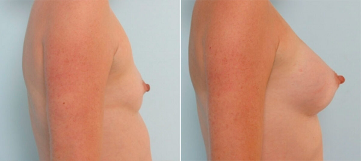 Breast Augmentation before and after photos in Houston, TX, Patient 34702