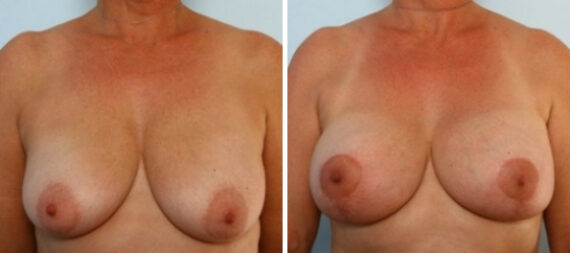 Breast Augmentation-Mastopexy before and after photos in Houston, TX
