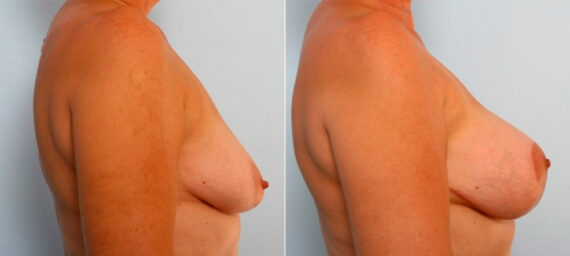 Breast Lift with Augmentation before and after photos in Houston, TX, Patient 34733