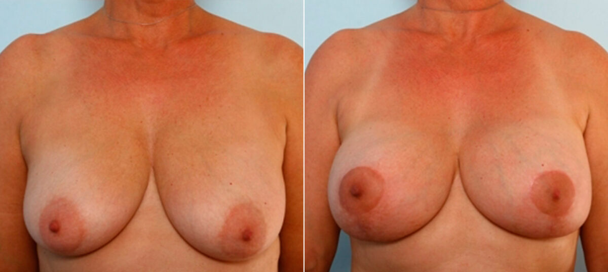 Patient 34733, Breast Lift with Augmentation before and after photos Breast Lift with Augmentation before and after photos in Houston, TX, Patient 34733