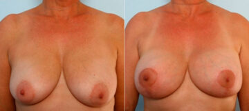 Breast Lift with Augmentation before and after photos in Houston, TX, Patient 34733