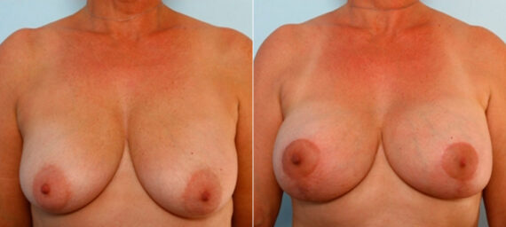 Breast Lift with Augmentation before and after photos in Houston, TX, Patient 34733