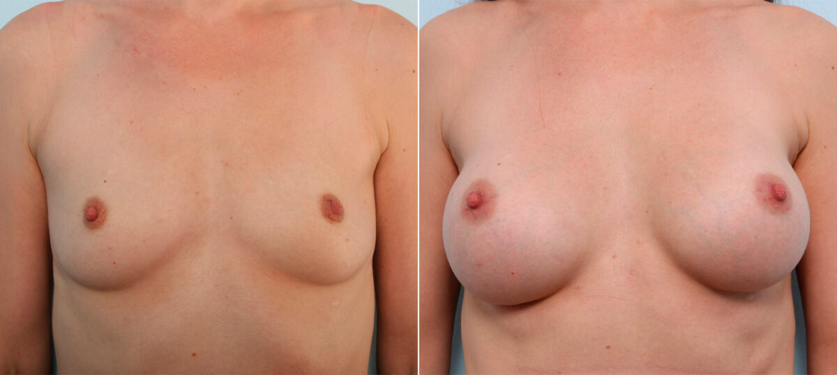 Breast Augmentation before and after photos in Houston, TX, Patient 41564
