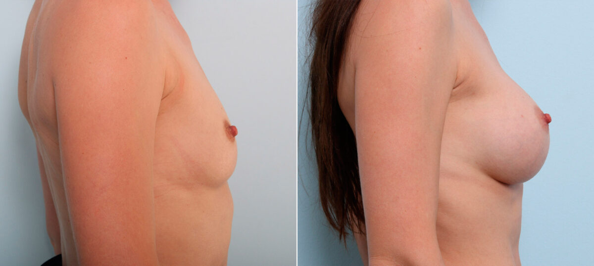 Breast Augmentation before and after photos in Houston, TX, Patient 41564
