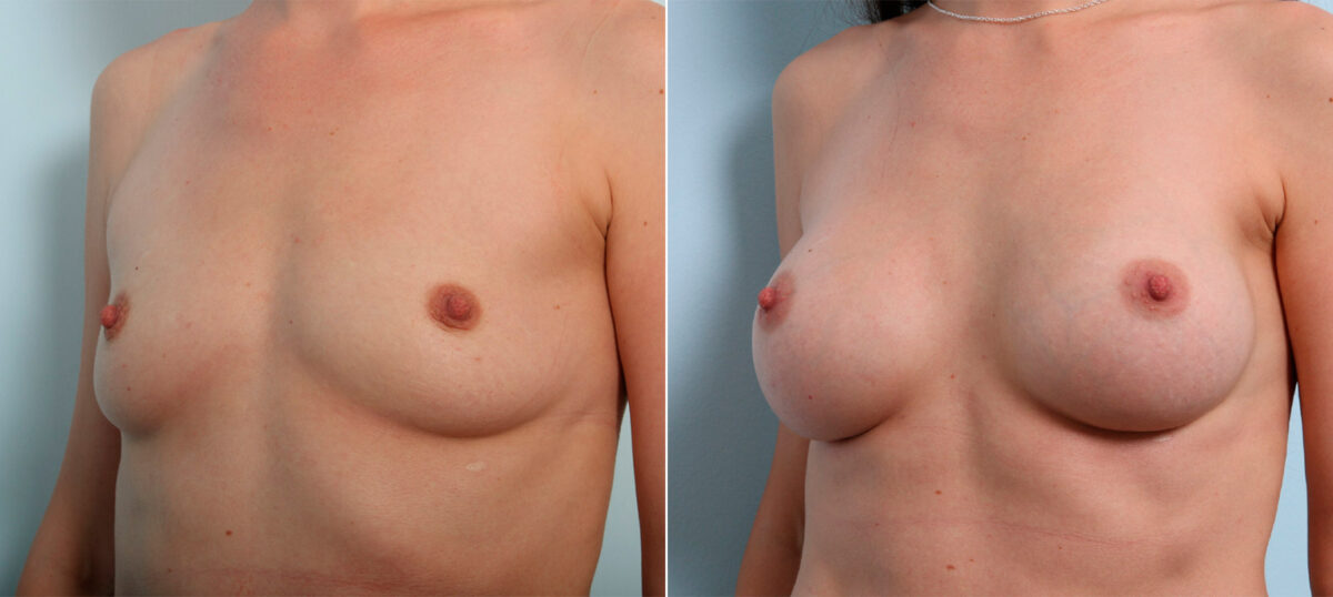 Breast Augmentation before and after photos in Houston, TX, Patient 41564