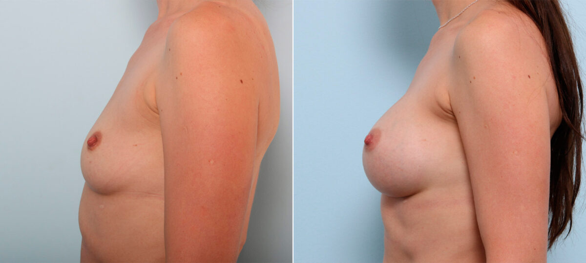 Breast Augmentation before and after photos in Houston, TX, Patient 41564