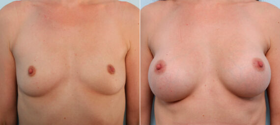 Breast Augmentation before and after photos in Houston, TX, Patient 41564