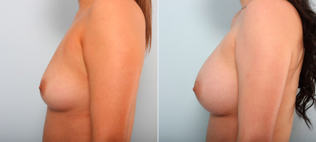 Breast Augmentation before and after photos in Houston, TX, Patient 41581