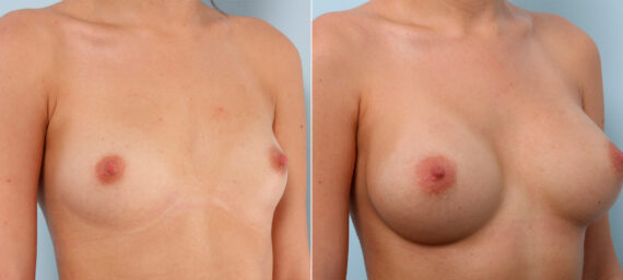 Breast Augmentation before and after photos in Houston, TX, Patient 41602