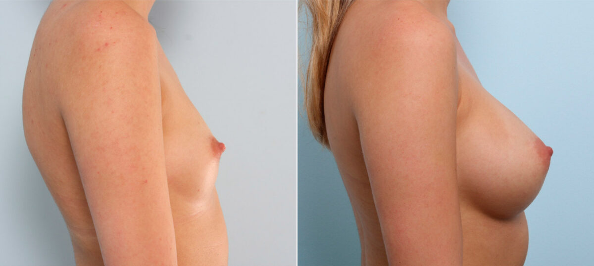 Breast Augmentation before and after photos in Houston, TX, Patient 41602