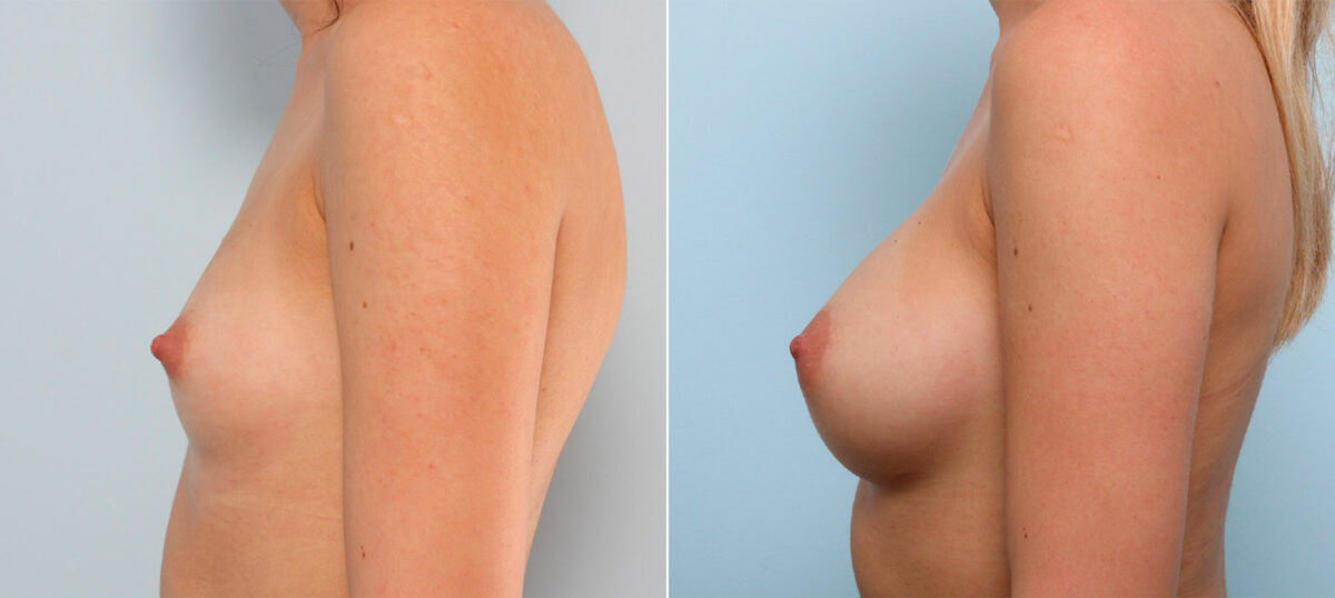 Breast Augmentation before and after photos in Houston, TX, Patient 41602